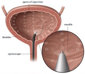 Botox Injections in Urology