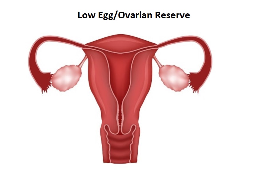 Diminished Ovarian Reserve Treatment in Bangalore