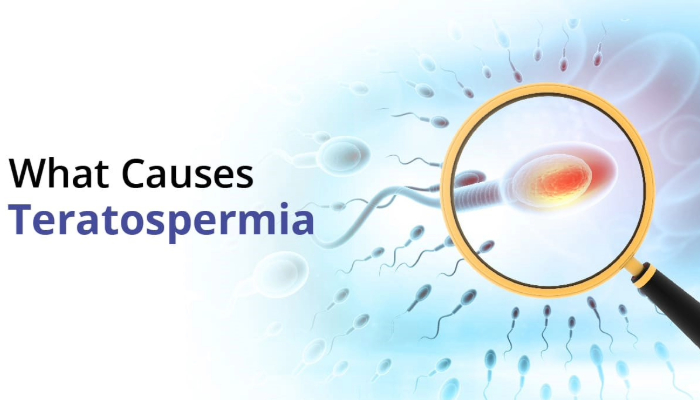 Unveiling Teratospermia / Teratozoospermia: Decoding Abnormal Sperm Shapes and Fertility